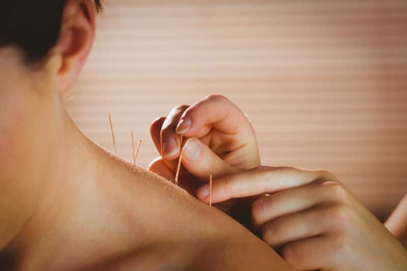 Acupuncture Treatment Birmingham